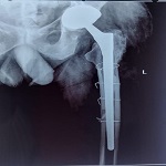 Spinal Surgery